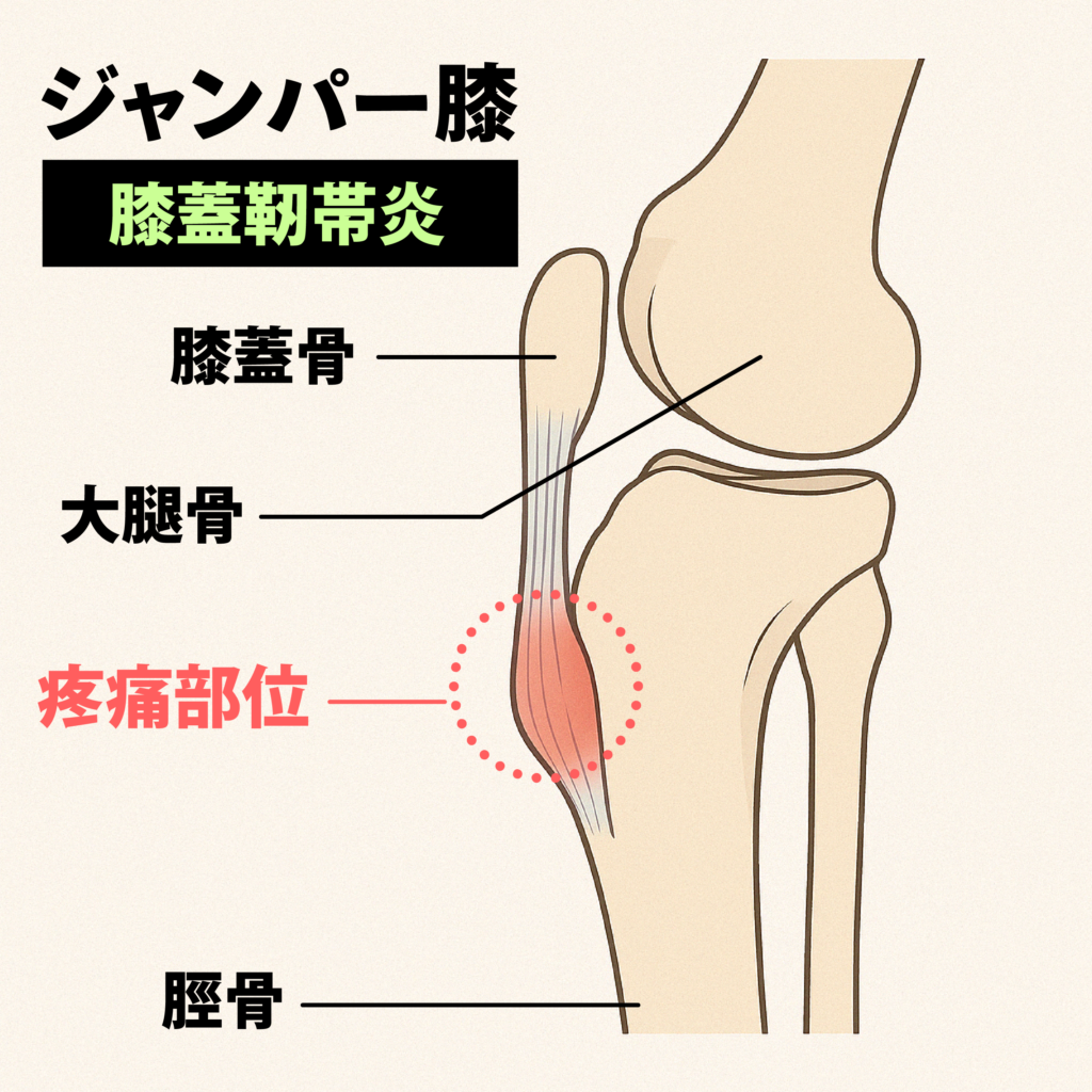 膝蓋靭帯炎の図解